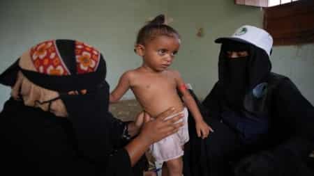 اليمن: 668 طفل يعانون من سوء التغذية في تبن بلحج