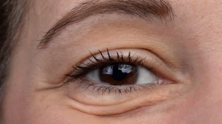 أمراض تدل عليها الانتفاخات تحت العين